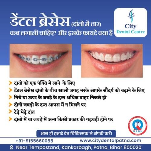 Dental Braces....